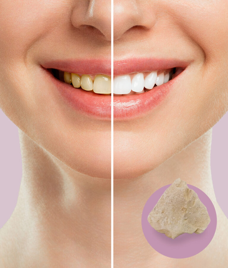 bimstein-whitening-depurdent